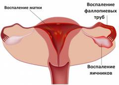 Почему болят яичники после месячных Почему болят яичники после месячных