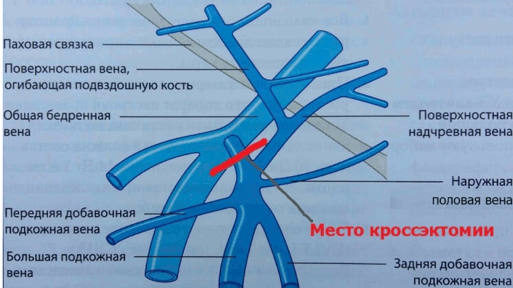 Удаление Варикозно Расширенной Вены