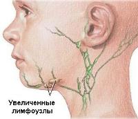 У ребенка воспалились лимфоузлы как лечить У ребенка воспалились лимфоузлы как лечить