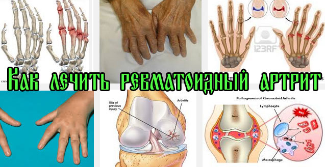 Избавится от ревматоидного артрита Избавится от ревматоидного артрита