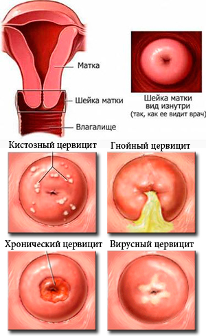 Цервицит и беременность отзывы Цервицит и беременность отзывы