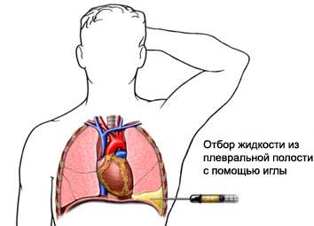Как убрать жидкость с легких в домашних условиях Как убрать жидкость с легких в домашних