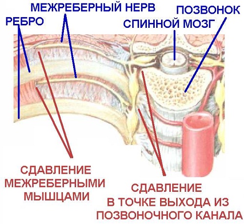 Межреберная невралгия симптомы и лечение в домашних условиях Межреберная невралгия симптомы и лечение в домашних