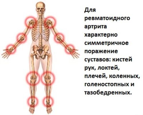 Сколько можно прожить при ревматоидном артрите Сколько можно прожить при ревматоидном артрите