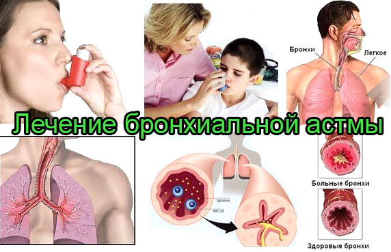 Бронхиальная астма что это такое и как лечить Бронхиальная астма что это такое и как лечить