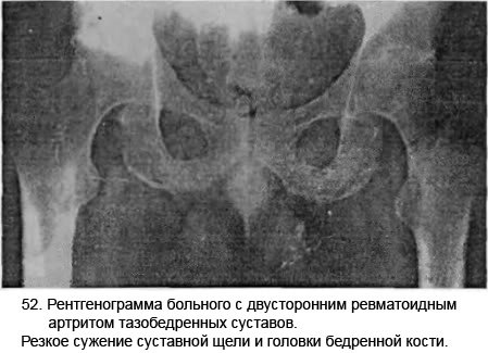 Кистозные перестройки тазобедренных суставов Кистозные перестройки тазобедренных суставов