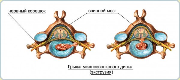 Экструзия позвоночника Экструзия позвоночника
