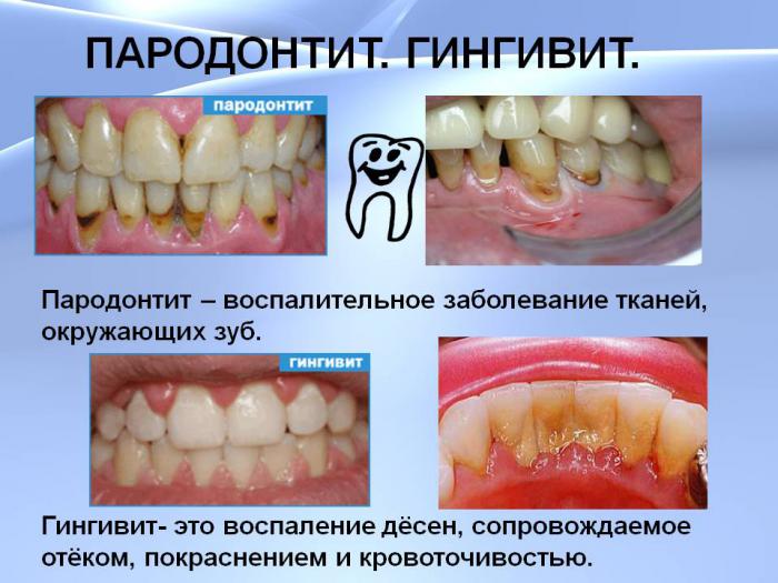 Болит десна чем-то уколол Болит десна чем-то уколол