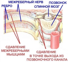 Как лечить межреберную невралгию какими мазями Как лечить межреберную невралгию какими мазями