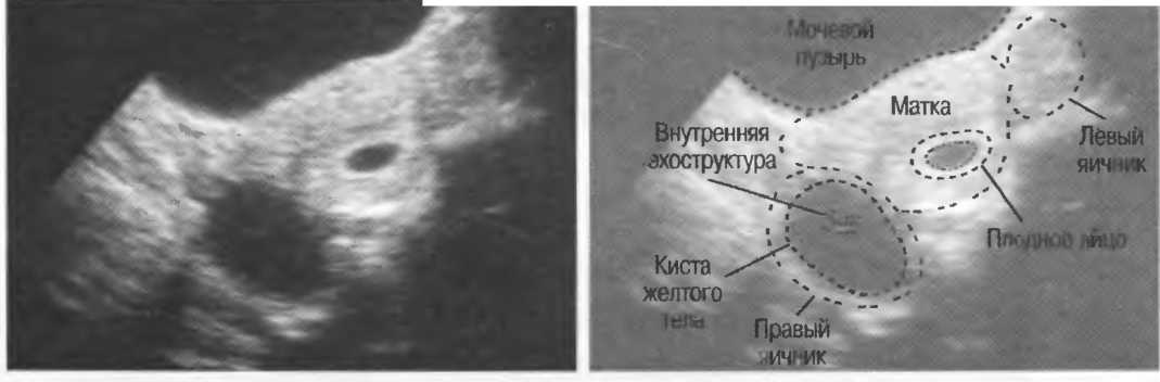 Киста может себя проявить как беременность Киста может себя проявить как беременность
