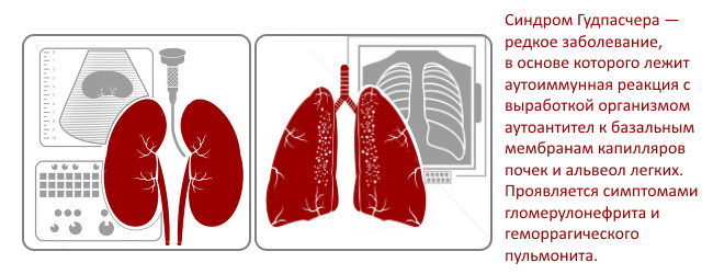 Синдром гудпасчера это. Синдром Гудпасчера этиология. Синдром Гудпасчера клинические рекомендации. Гудпасчера кт легких болезнь. Синдром Гудпасчера легкие.