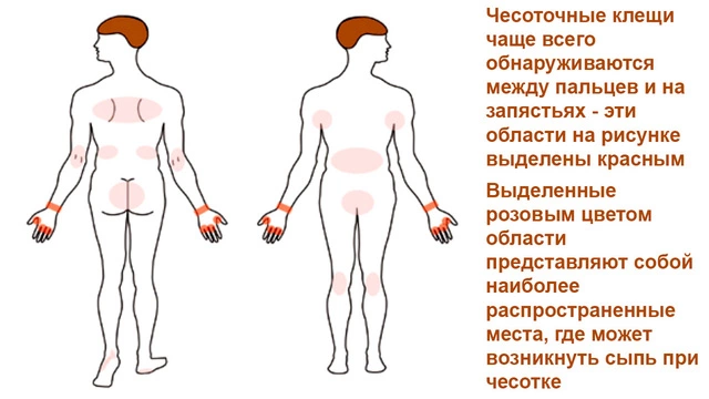 Чесотка На Половых Органах Фото