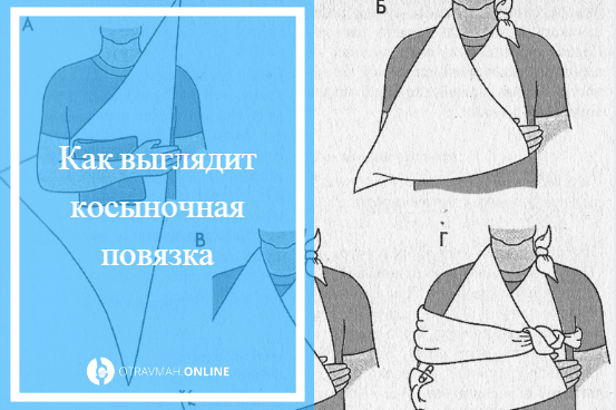 Как сделать перелом дома