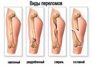 Что делать при переломе