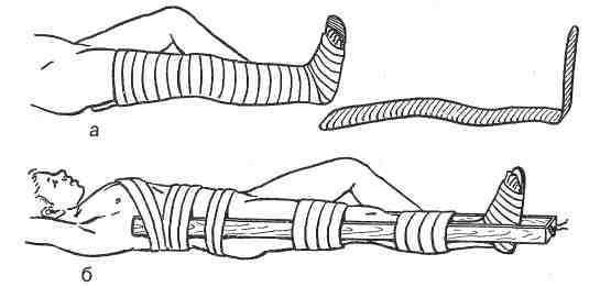 Транспортная иммобилизация при переломе костей голени. Иммобилизация конечности при переломе костей голени. Иммобилизация при переломе голени стопы. Умбиликация при переломе голени.