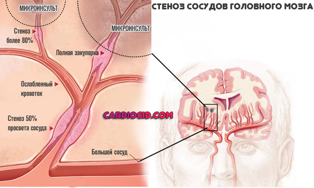 Лечение головных сосудов. Сужение сосудов головного мозга. Сужение артерий головного мозга. Стеноз артерий головного мозга. Стеноз мозговых артерий что это такое.