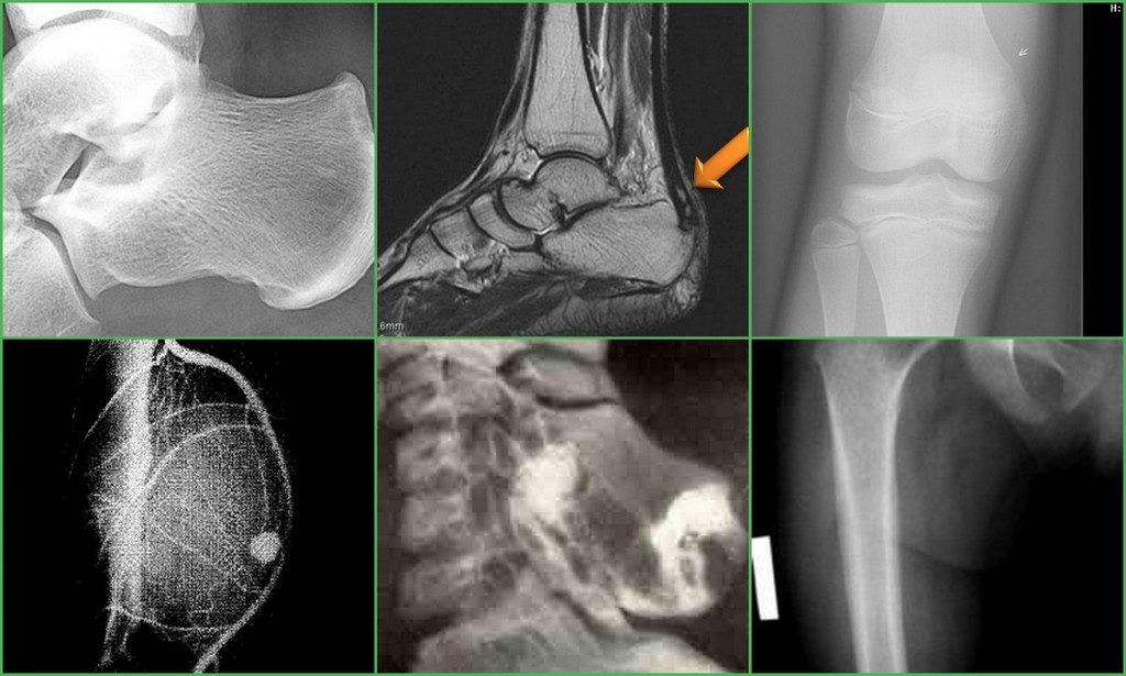 Экзостоз кости. Экзостоз пяточной кости. Экзостоз пяточной кости рентген. Остеома пяточной кости.