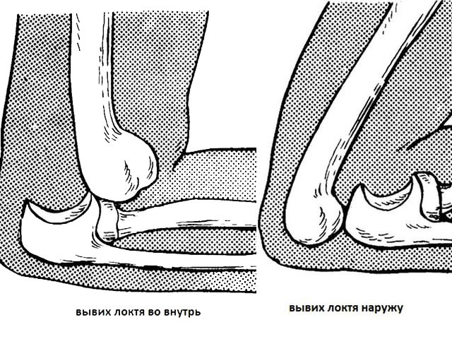 Задний вывих локтевого сустава. Вывихнул локоть. Травматический вывих локтевого сустава. Вывих с переломом локтевого сустава. Вывихнул локоть.