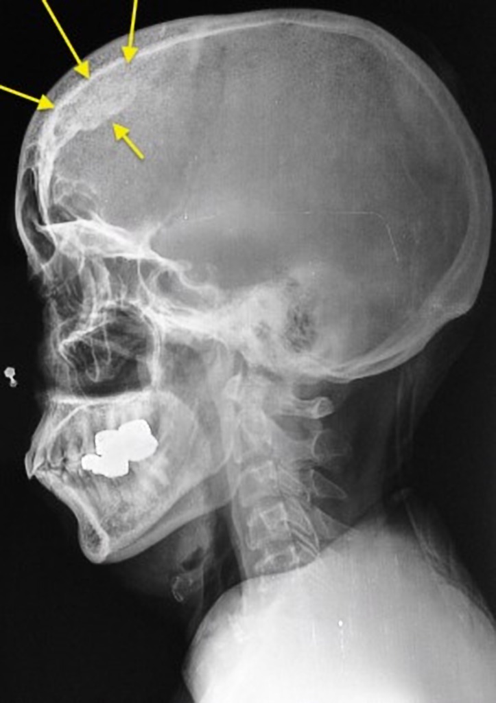 Остеома черепа рентген фото