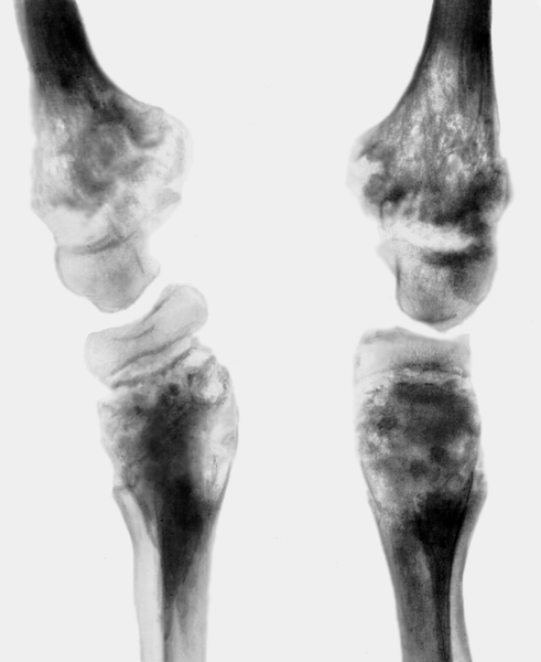 Эпифизарная дисплазия голеней рентген. Экзостозная хондродисплазия. Экзостозная дисплазия. Эпифизарная дисплазия. Эпифизарная хондродисплазия.