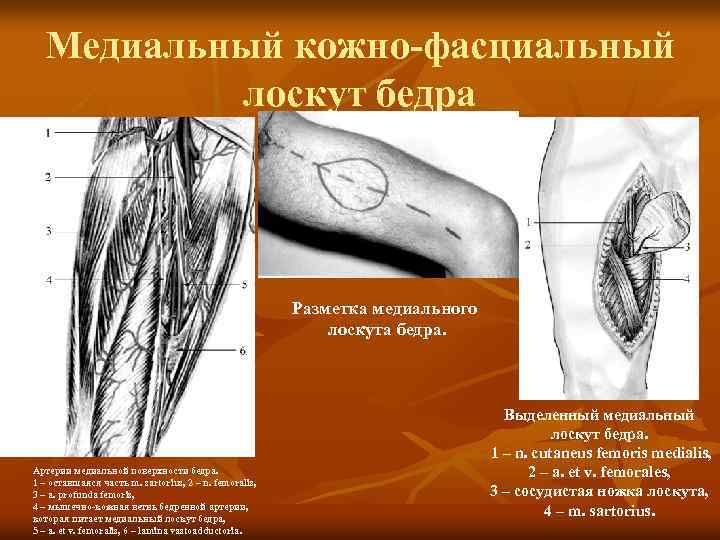 Проекционная линия бедренной артерии. Кожно фасциальный лоскут. Медиальный кожно-фасциальный лоскут бедра. Медиальная поверхность бедра.