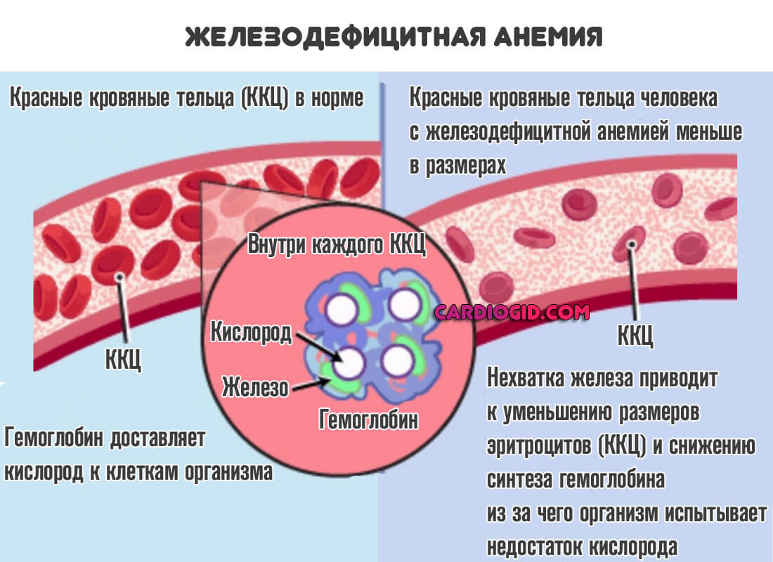 Причины анемии крови. Железодифицитная Анимия. Железнодефецитная Анимия. Железодефицитная анемия норма. Железодефицитная анемия (жда).