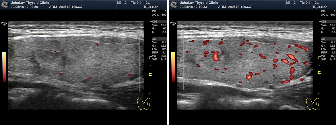 Что значит в режиме цдк. Ультразвуковое исследование щитовидной железы. УЗИ щитовидной железы ЦДК что это. Тиреоидит щитовидной железы на УЗИ. Гиперваскуляризация щитовидной железы.