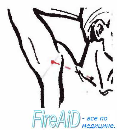 Лимфоузлы под мышкой схема