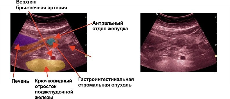 Гастроинтестинальная стромальная опухоль. Гастроинтестинальные стромальные опухоли желудка. Стромальные опухоли ЖКТ.