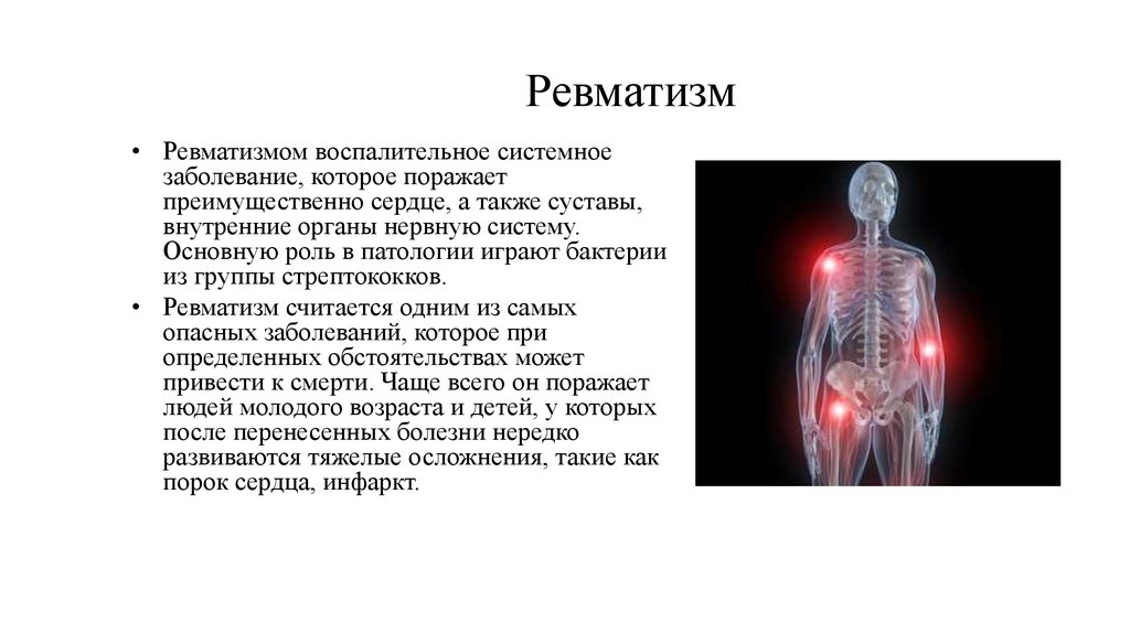 Ревматизм что. Ревматическое поражение нервной системы. Ревматизм жалобы.