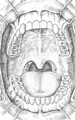 Ротовая полость рисунок. Гипертрофия слизистой оболочки твердого неба. Небо ротовой полости анатомия. Слюнные железы на твердом небе.