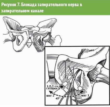 Блокада нерва. Проводниковая анестезия запирательного нерва. Блокада запирательного нерва. Блокада запирательного нерва техника. Блокада запирательного отверстия.