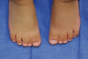 Корткикпальцы на ногах. Синдактилия это в патологии. Перепончатая синдактилия. Наследственная синдактилия. Наследственная синдактилия.