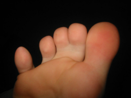 Перепонки на пальцах ног. Перепонки на пальцах ног. Полидактилия верхних конечностей. Перепонки на пальцах ног. Перепонки на пальцах ног.