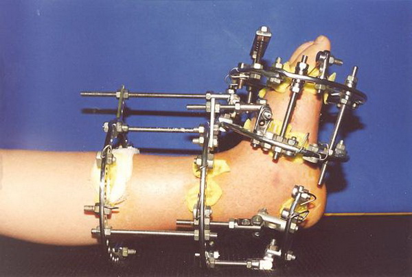 Аппарат илизарова купить. Компрессионно-дистракционный аппарат Илизарова. Компрессионно дистракционный аппарат Елизарова. Компрессионно-дистракционный остеосинтез аппаратом Илизарова. Аппарат Илизарова голень стопа.