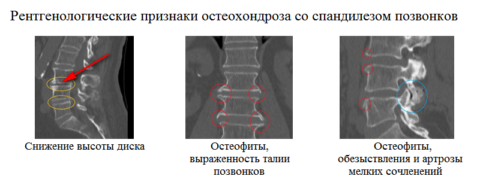 Спондилоартроз шейного отдела позвоночника рентген. Кт признаки остеохондроза. Остеохондроз шейного отдела позвоночника рентген признаки. Миелопатия шейного отдела позвоночника мрт. Остеохондроз поясничного отдела позвоночника мрт.