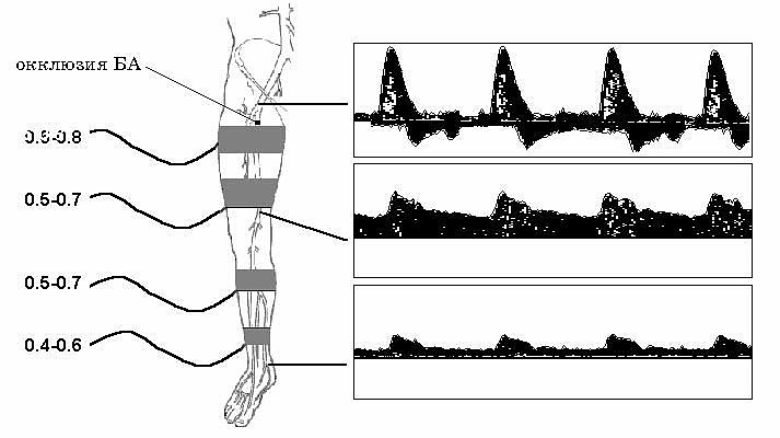 Окклюзия ноги. Коллатеральный Тип кровотока. Коллатеральный кровоток в нижних конечностях на УЗИ. Коллатеральный кровоток в нижних конечностях что это. Кровоток магистральный коллатеральный магистральный измененный.