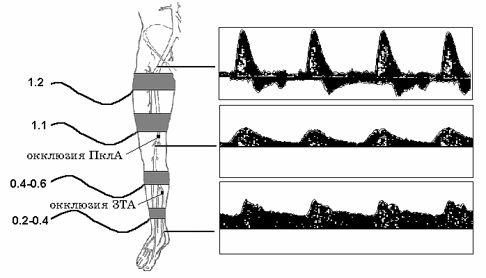 Окклюзия кровотока. Окклюзионное поражение периферических артерий нижних конечностей. Окклюзия артерий нижних конечностей УЗИ. УЗИ артерий конечностей окклюзия протокол. Магистральный коллатеральный кровоток.