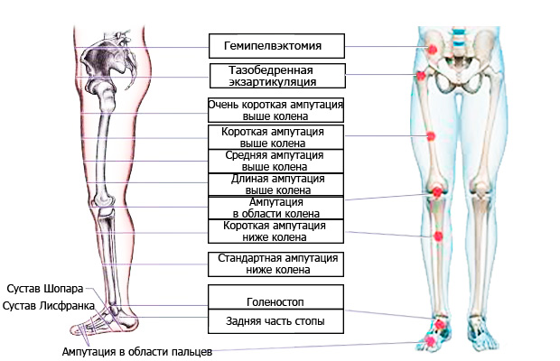 Уровни ампутации нижней конечности. Ампутация стопы нижней конечности. Ампутация нижней конечности на уровне бедра. Ампутация нижней конечности на уровне средней трети.