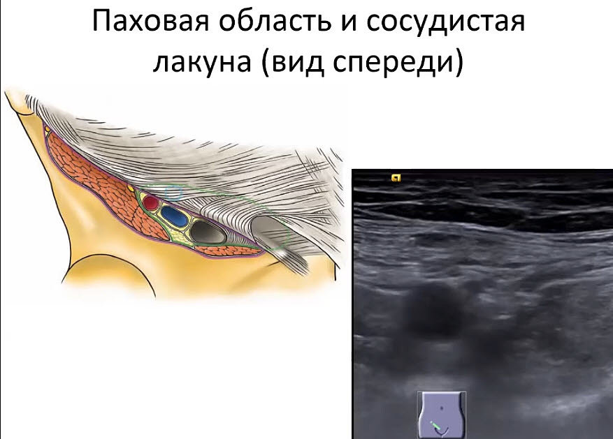 Паховая грыжа отзывы. Наружное паховое кольцо на УЗИ. Ультразвуковая анатомия паховой грыжи. Грыжа сосудистой лакуны. Паховый канал грыжа УЗИ.