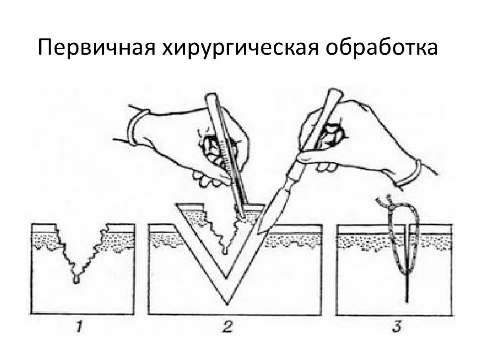 Схема пхо раны