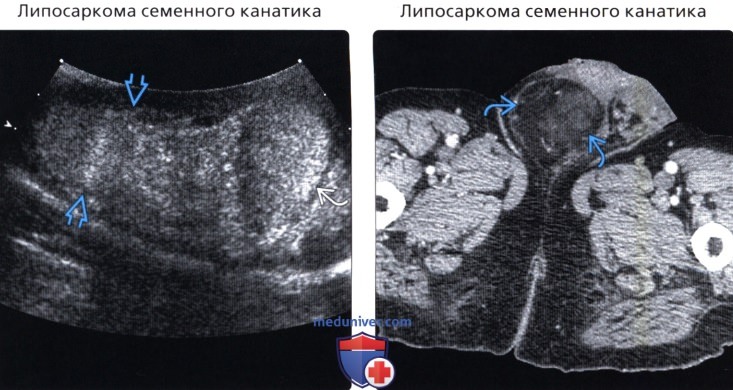 Узи Фото Липосаркома Мягких Тканей