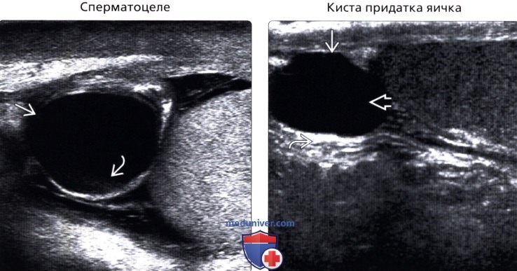 Сперматоцеле после. Сперматоцеле яичка УЗИ. Киста семенного канатика УЗИ картина.
