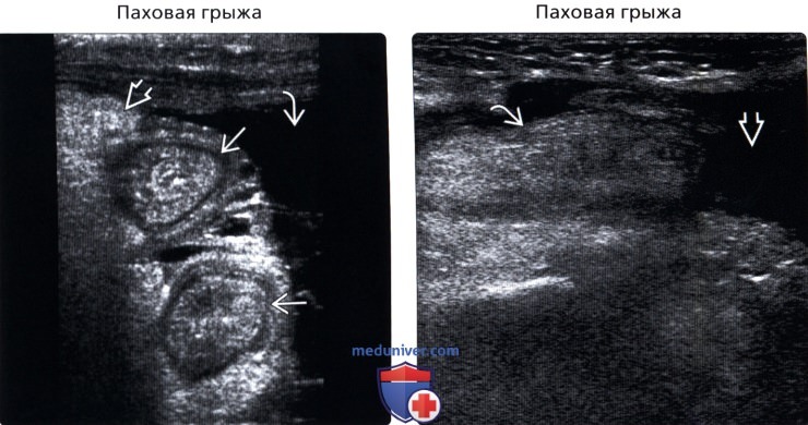 Пахово мошоночная грыжа