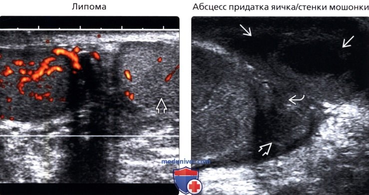 Жидкость в оболочках яичка на узи. Водянка семенного канатика узи. Водянка оболочек яичка. Диагностика водянки яичка. Диагностика водянки яичка.
