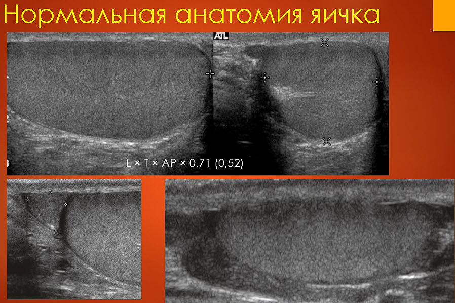 Узи яичек. Ультразвуковая анатомия органов мошонки. УЗИ анатомия органов мошонки. УЗИ мошонки видеолекция.