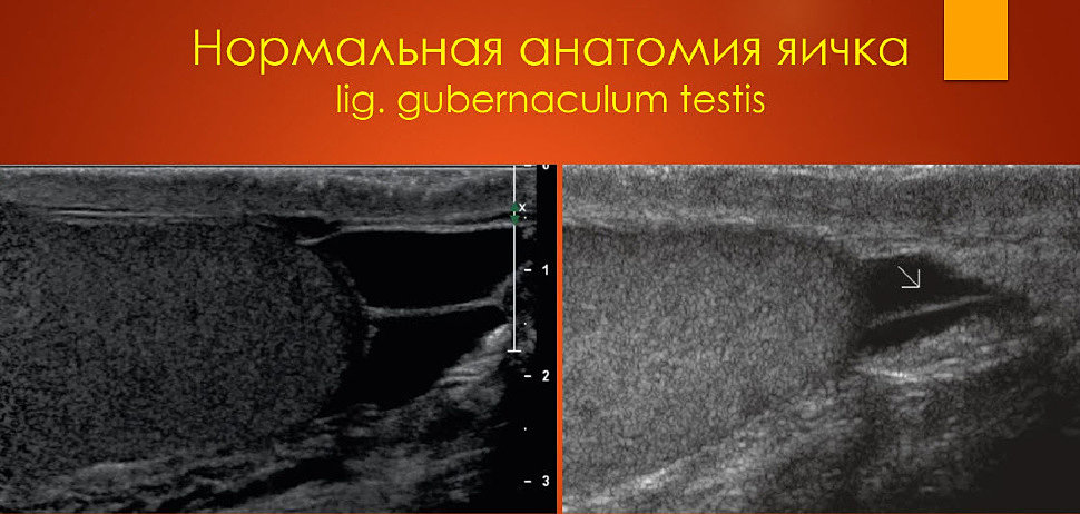 Узи яичек. Перекрут гидатиды яичка УЗИ. Гематоцеле яичка УЗИ картины. Ультразвуковая анатомия органов мошонки.