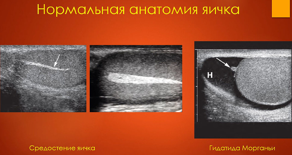 Узи яичек. УЗИ анатомия органов мошонки. Нормальная картина УЗИ мошонки. УЗИ органов мошонки с ЦДК. Патология в органах мошонки.