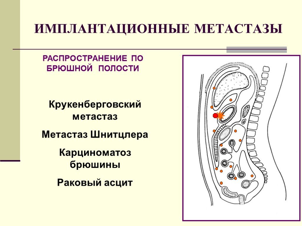 Карциноматоз брюшины что это. Имплантационные метастазы. Имплантационное метастазирование это. Импоантационное метастазы. * Имплантационные метастазы в брюшине.