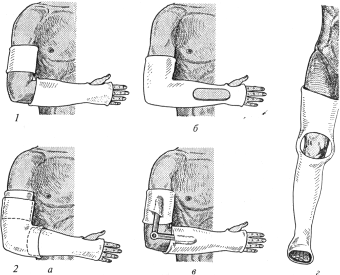 Лонгетно-циркулярная гипсовая повязка. Десмургия гипсовые повязки. Лечебная иммобилизация гипсовой повязкой. Гипсовая иммобилизация локтевого сустава.